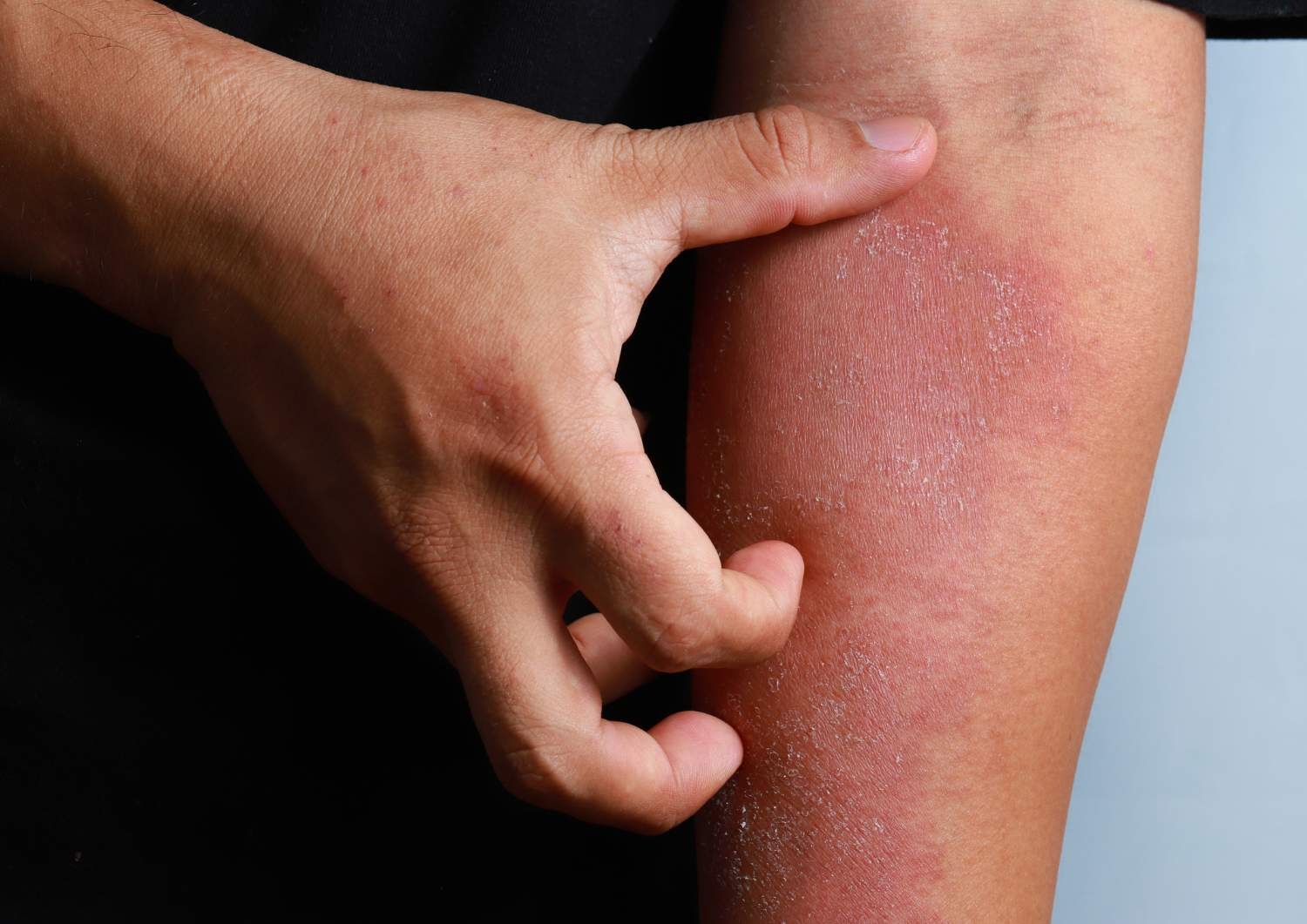 Eczema Eczema